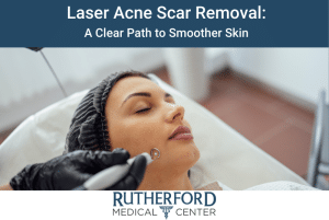 laser acne scar removal a clear path to smoother skin